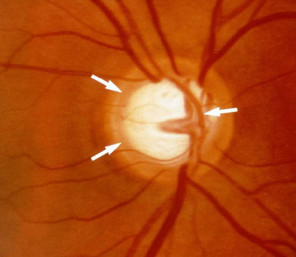 glaucoma5
